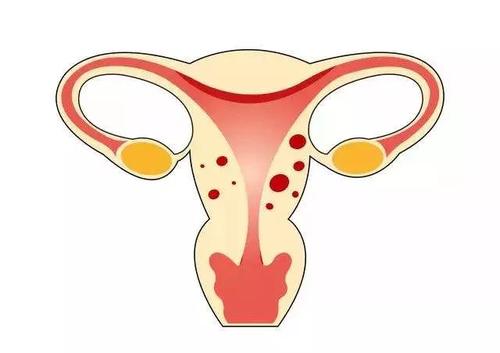 咸阳女性患子宫内膜炎的病因是什么