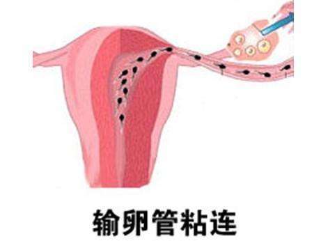 咸阳女性宫外孕有可能是输卵管粘粘所致