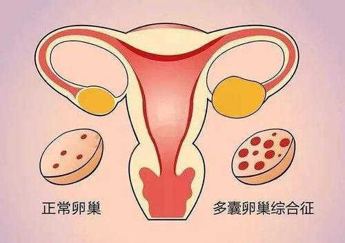 兴义妇女多囊卵巢是怎么引起的