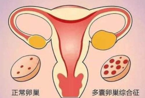 咸阳妇女如何确诊多囊卵巢综合症